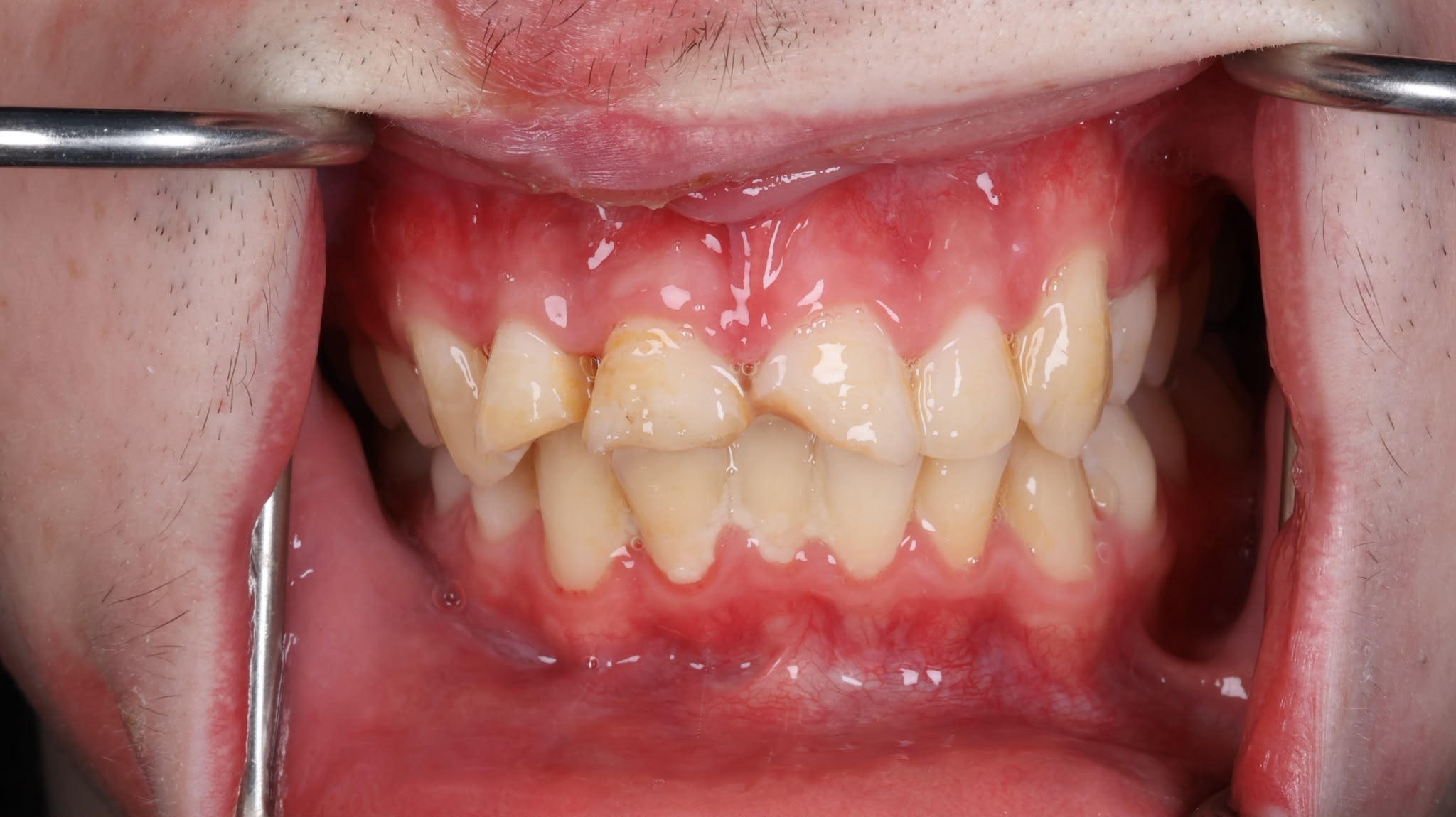 Before treatment result