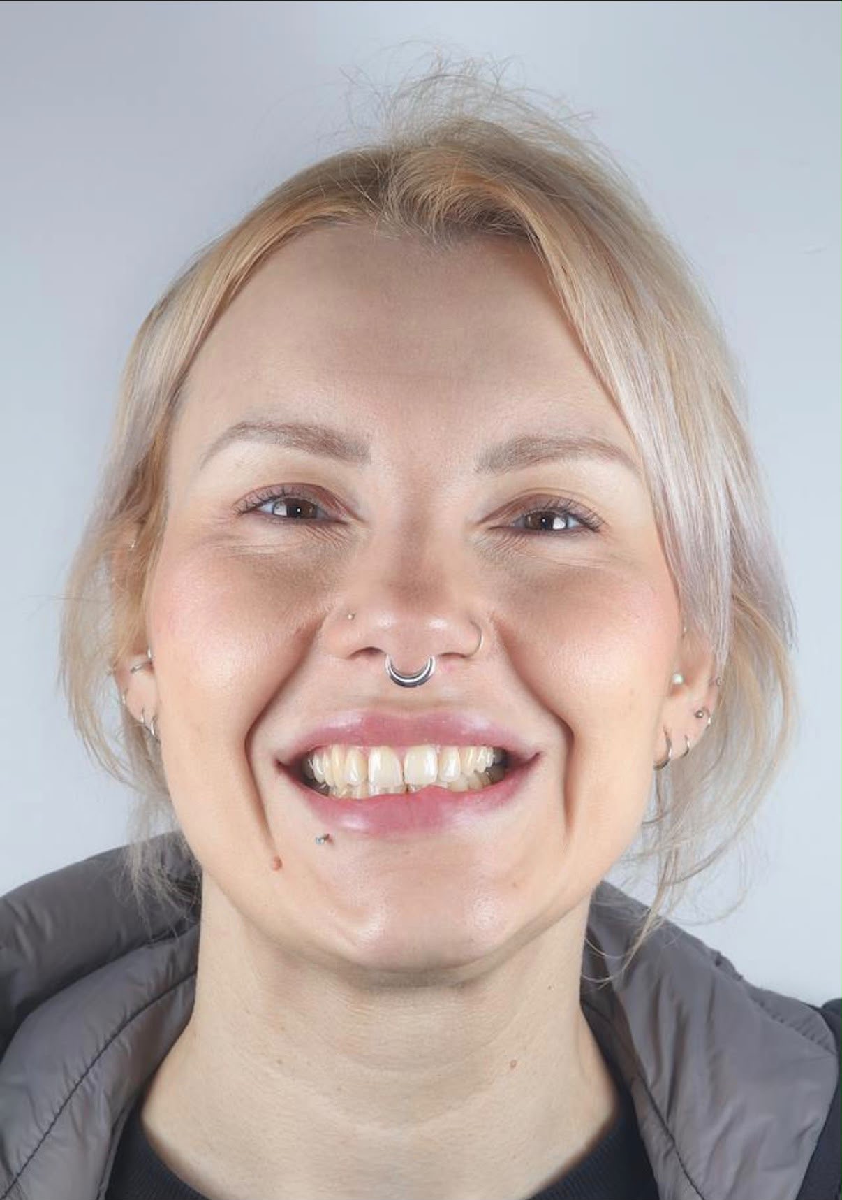 Before treatment result