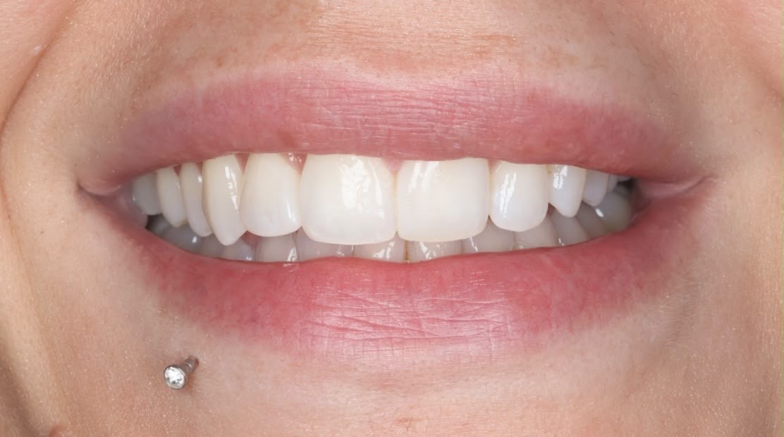 After treatment result