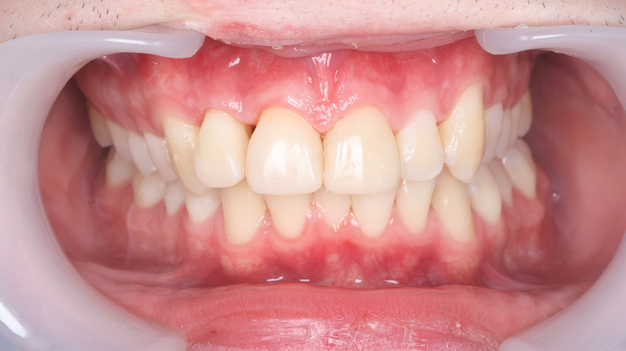 After treatment result