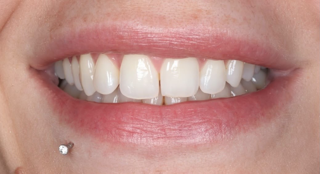 Before treatment result