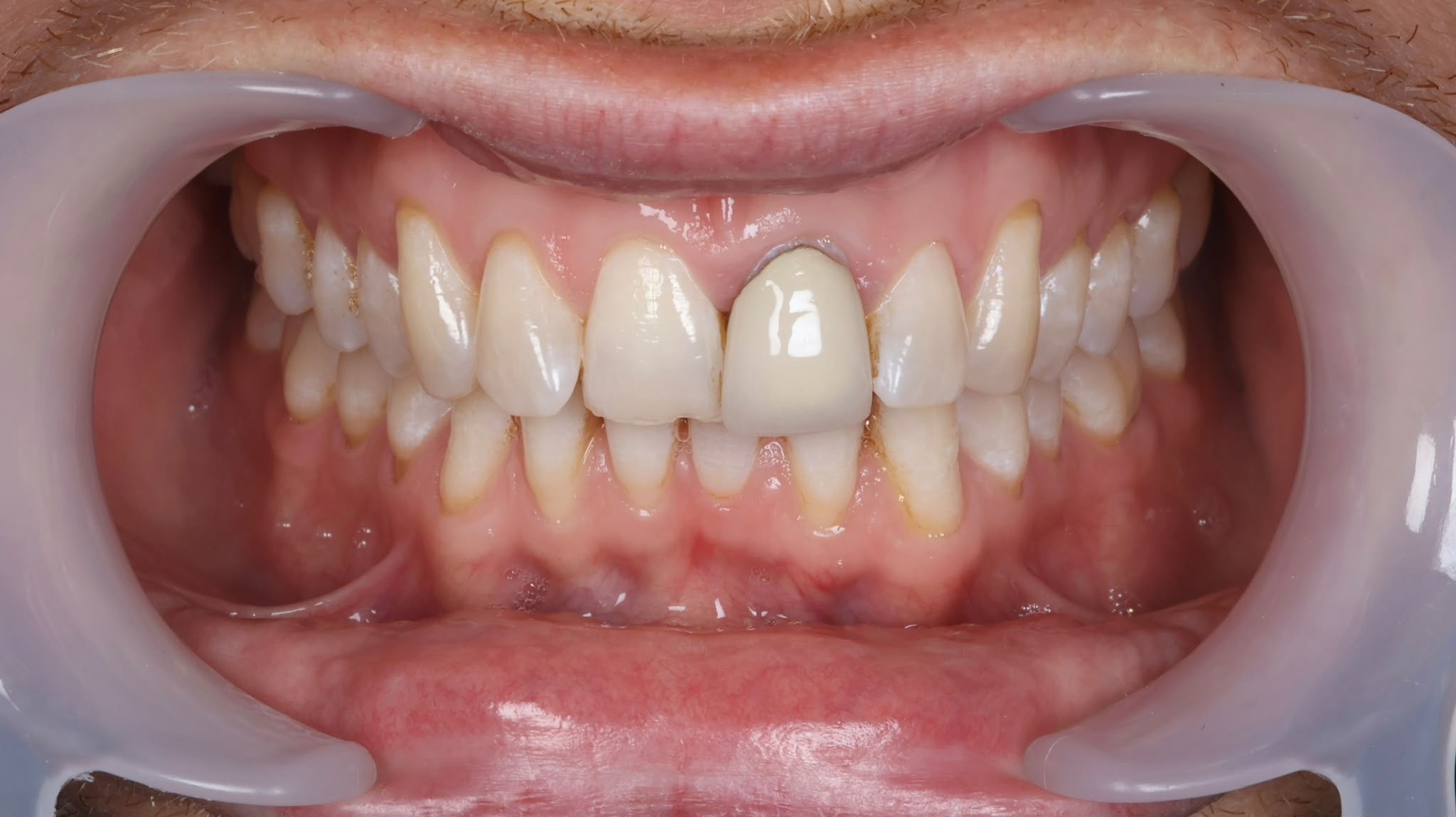 Before treatment result