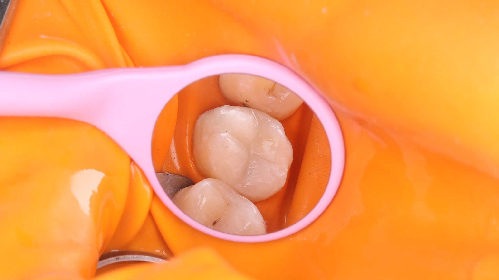 Dental treatment before-and-after comparison 2