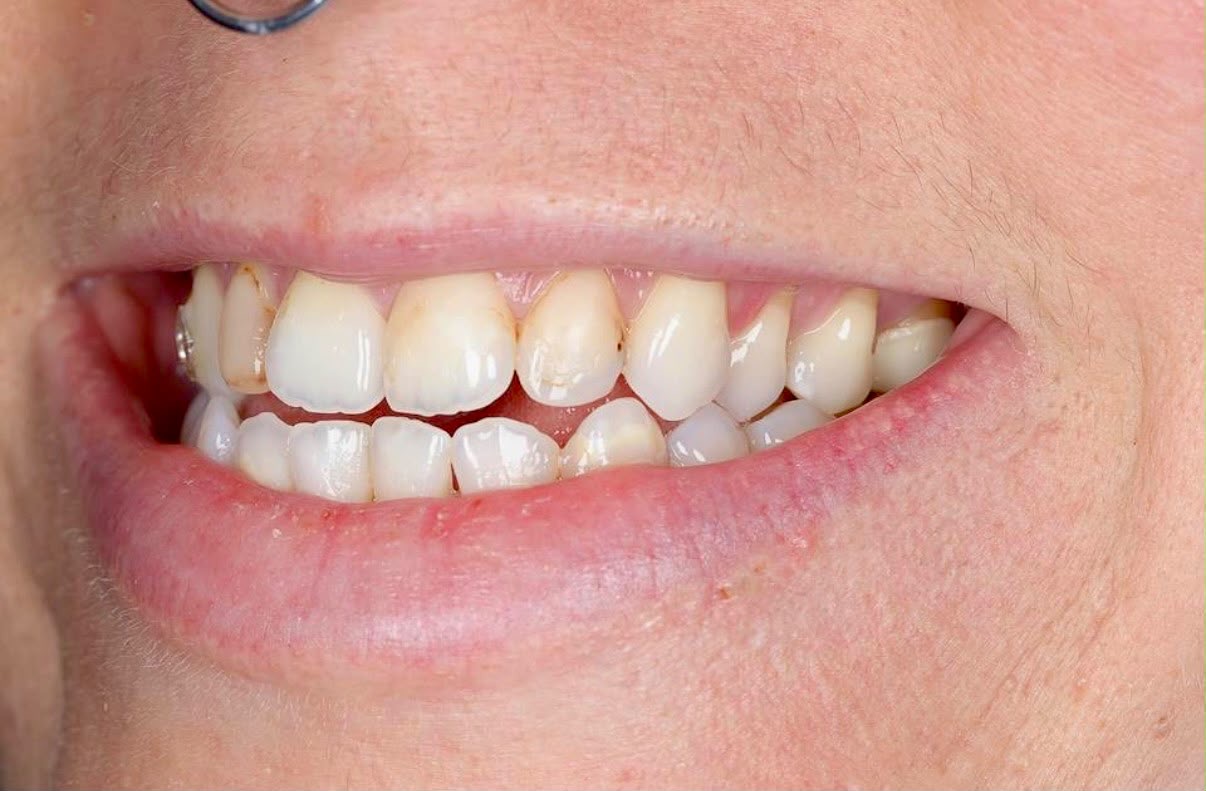 Before treatment result