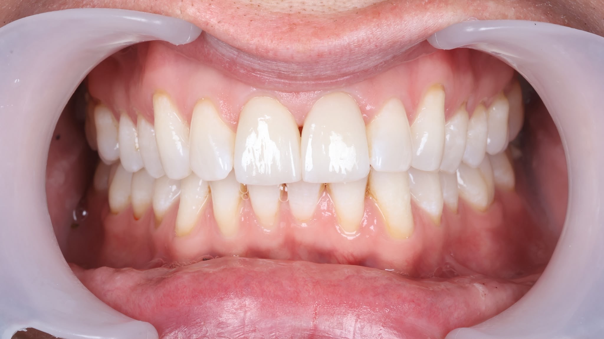 After treatment result