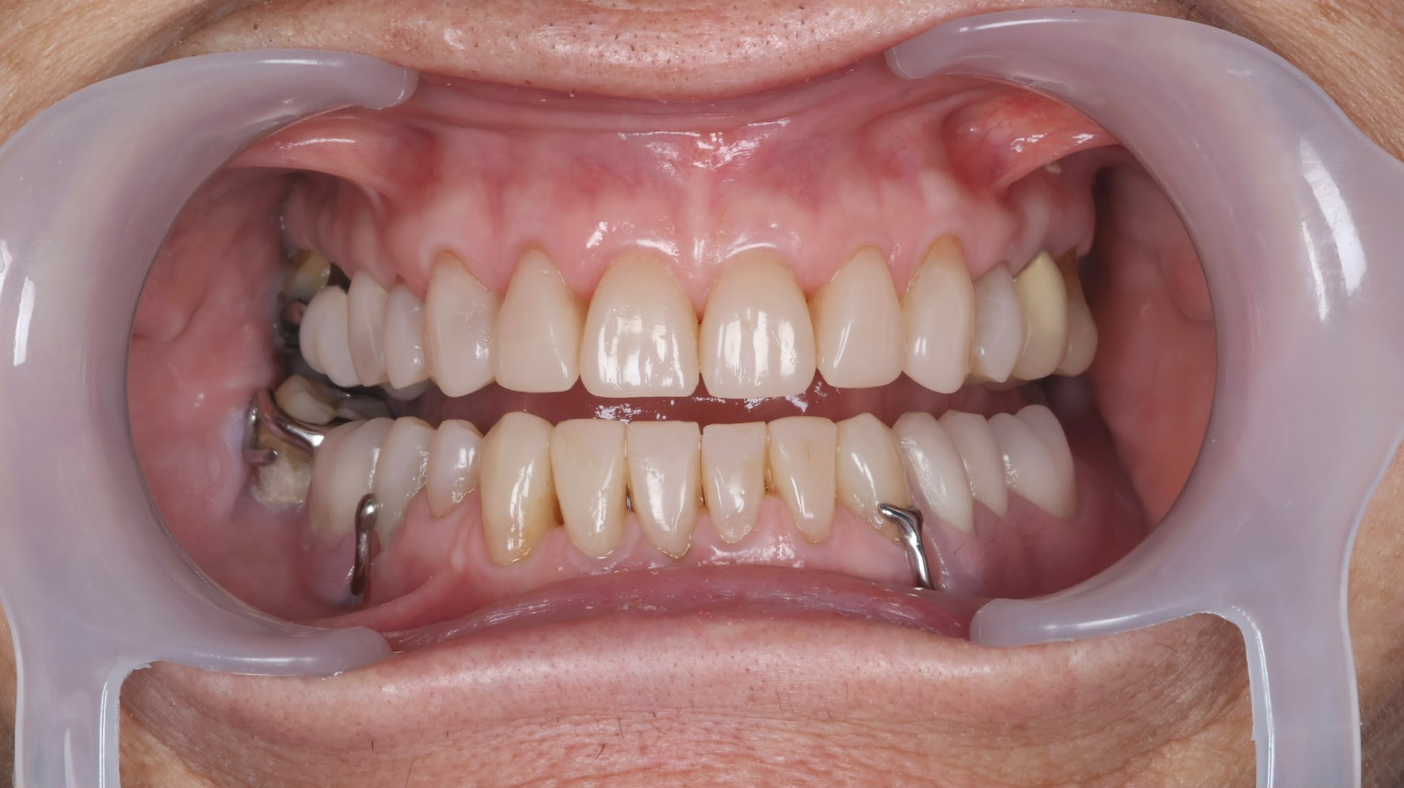 After treatment result
