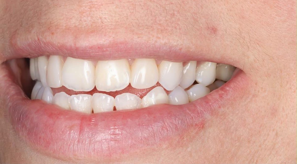 After treatment result