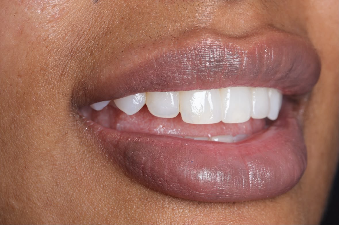 Dental treatment before-and-after comparison 1